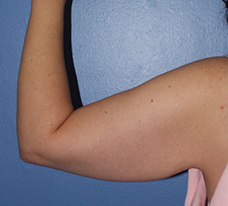 After Weight Loss Before & After Gallery - Patient 3891433 - Image 15