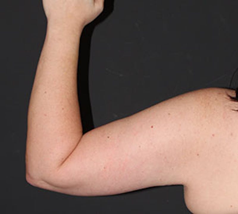 After Weight Loss Before & After Gallery - Patient 3891433 - Image 16