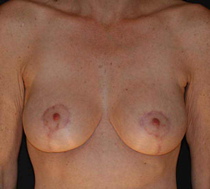 Augmentation-Mastopexy (Implant with Lift) Before & After Gallery - Patient 3891439 - Image 2
