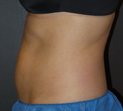 CoolSculpting® Before & After Gallery - Patient 3891440 - Image 1