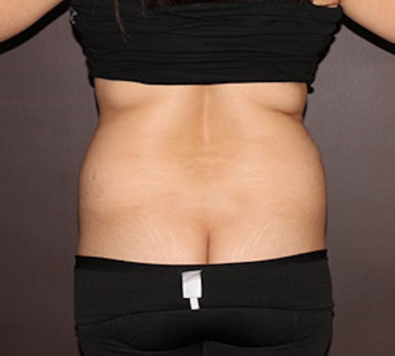 Liposuction Gallery - Patient 3891435 - Image 1