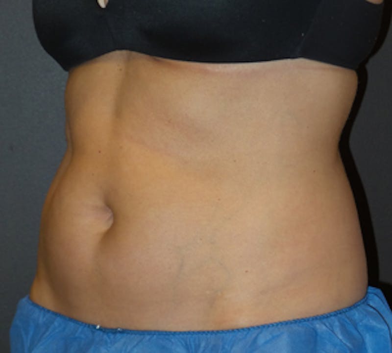 CoolSculpting® Before & After Gallery - Patient 3891440 - Image 3
