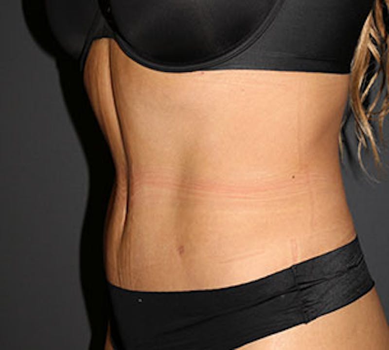 Abdominoplasty (Tummy Tuck) Before & After Gallery - Patient 3891436 - Image 8