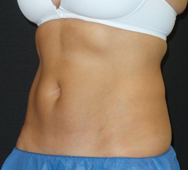 CoolSculpting® Before & After Gallery - Patient 3891440 - Image 4