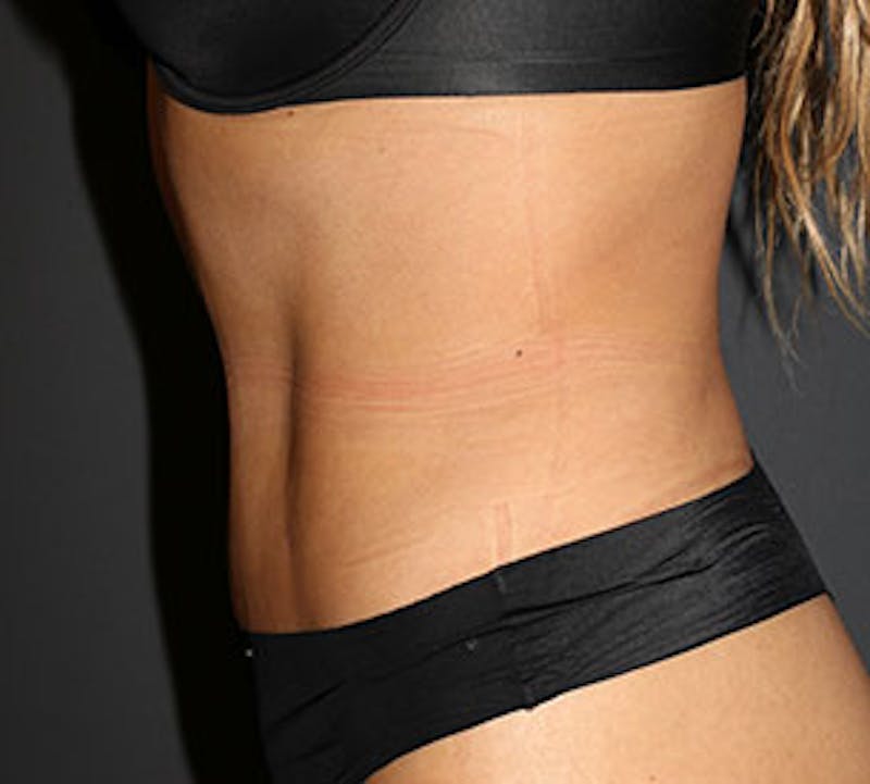 Abdominoplasty (Tummy Tuck) Before & After Gallery - Patient 3891436 - Image 10