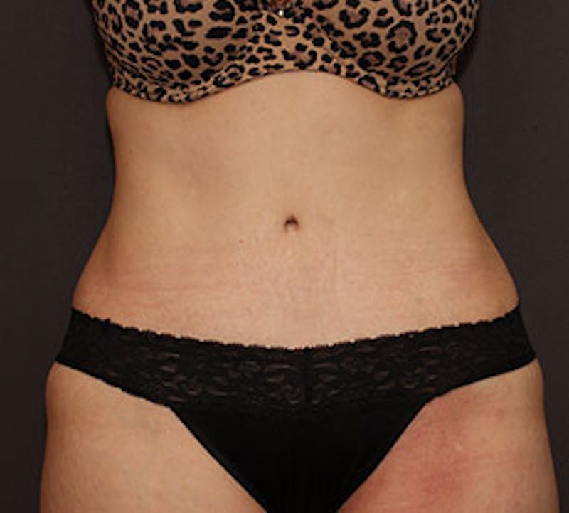 Abdominoplasty (Tummy Tuck) Before & After Gallery - Patient 3891443 - Image 2