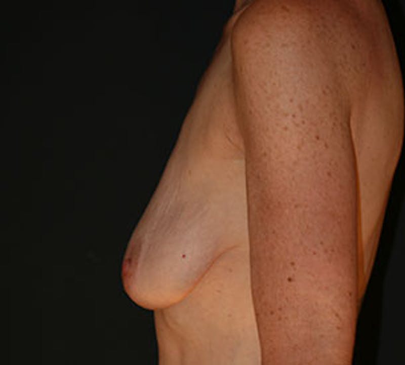 Augmentation-Mastopexy (Implant with Lift) Before & After Gallery - Patient 3891439 - Image 9