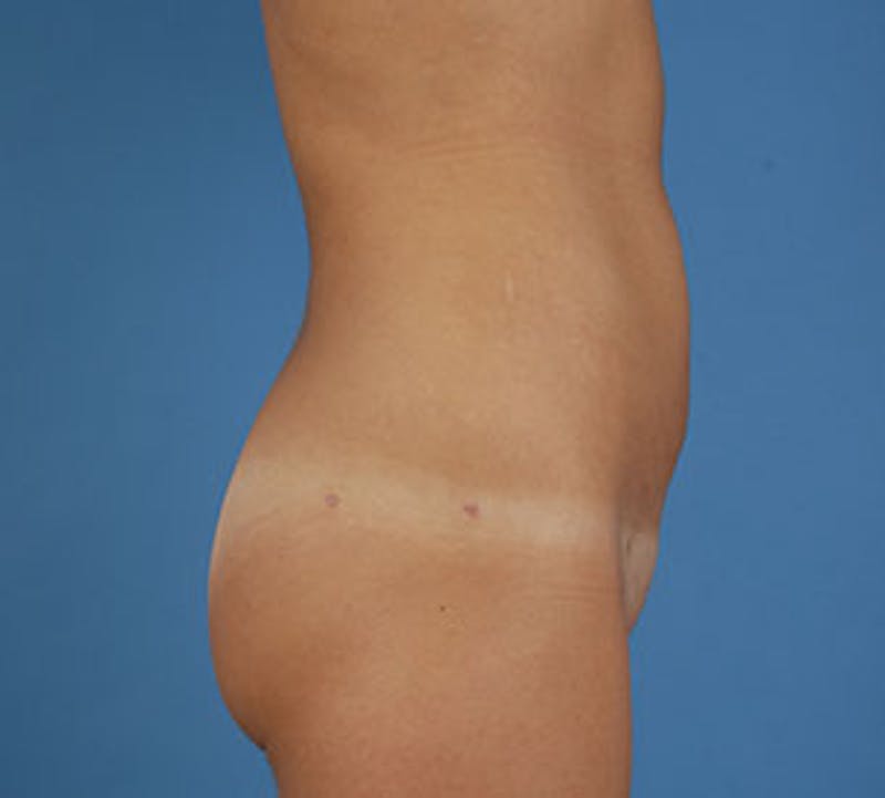 Liposuction Before & After Gallery - Patient 3891442 - Image 4
