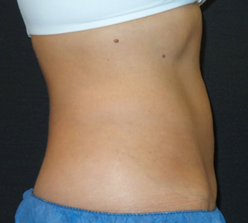CoolSculpting® Before & After Gallery - Patient 3891440 - Image 10