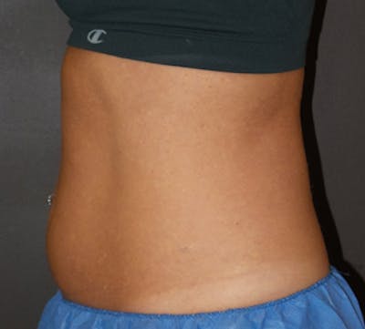 CoolSculpting® Before & After Gallery - Patient 3891454 - Image 1