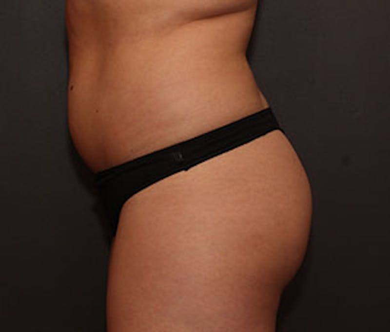 Brazilian Butt Lift Before & After Gallery - Patient 3891452 - Image 9