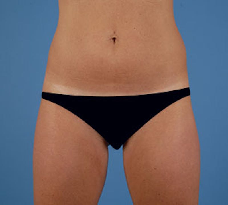 Liposuction Before & After Gallery - Patient 3891458 - Image 1