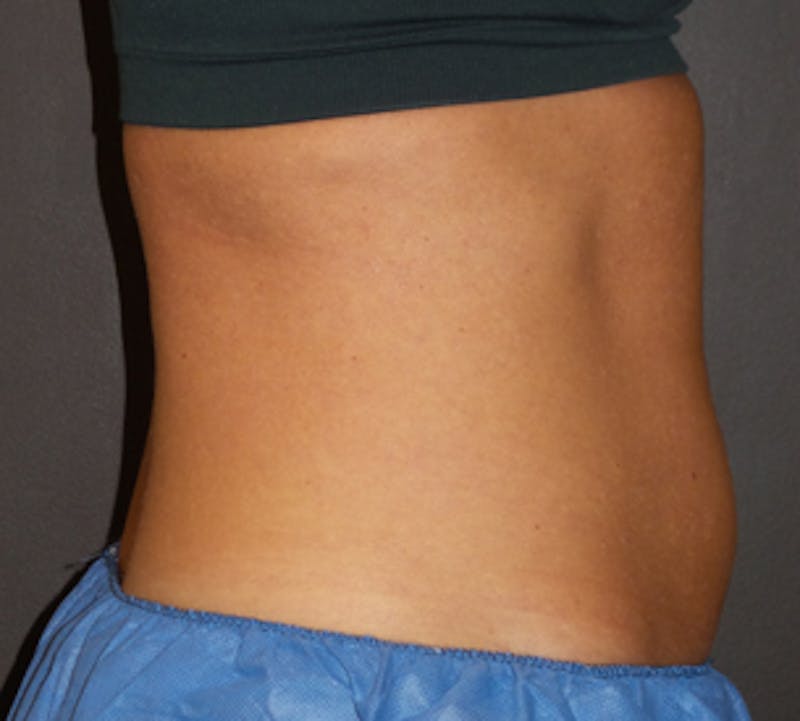 CoolSculpting® Before & After Gallery - Patient 3891454 - Image 9