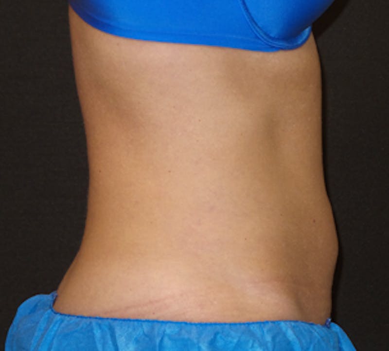 CoolSculpting® Before & After Gallery - Patient 3891454 - Image 10