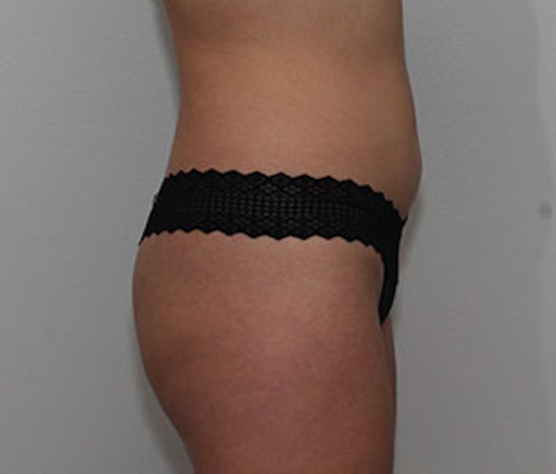 Brazilian Butt Lift Before & After Gallery - Patient 3891461 - Image 5