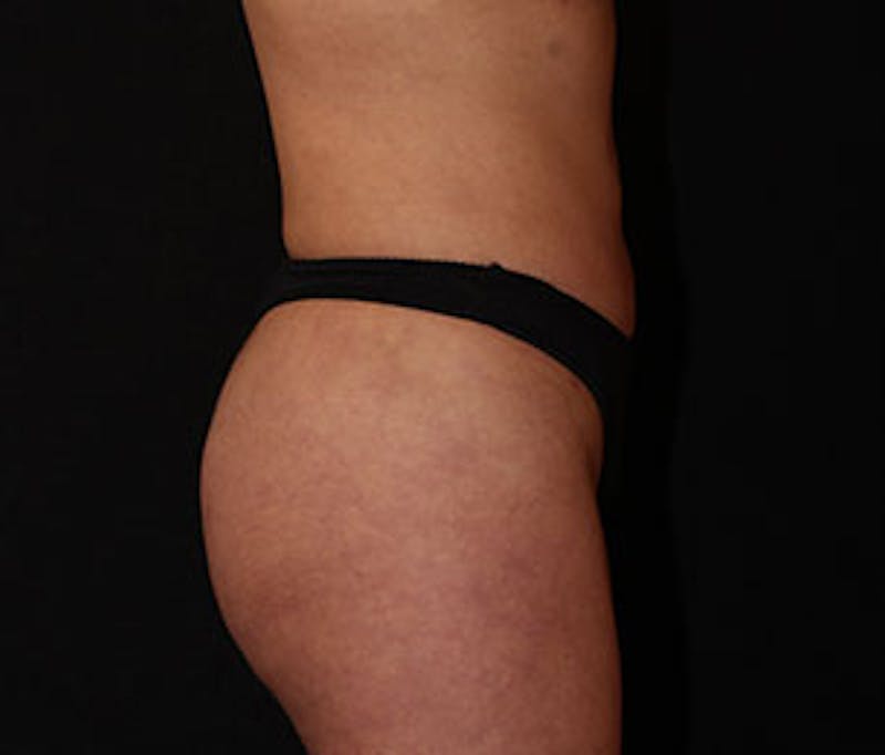 Brazilian Butt Lift Before & After Gallery - Patient 3891461 - Image 6
