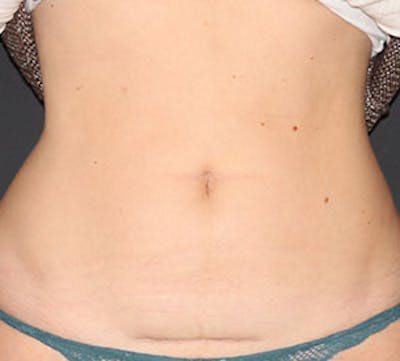 Liposuction Before & After Gallery - Patient 3891467 - Image 1