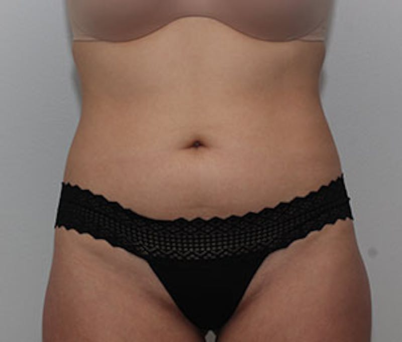 Brazilian Butt Lift Before & After Gallery - Patient 3891461 - Image 11