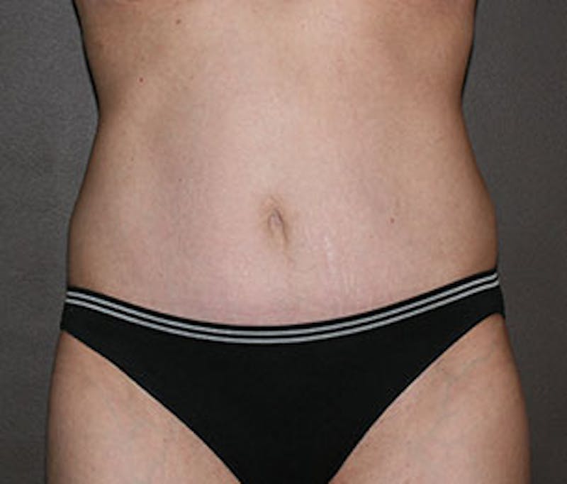 Mommy Makeover Before & After Gallery - Patient 3891472 - Image 4
