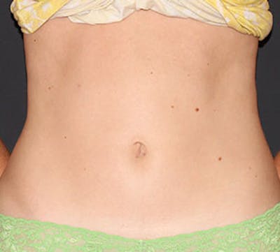Liposuction Before & After Gallery - Patient 3891467 - Image 2