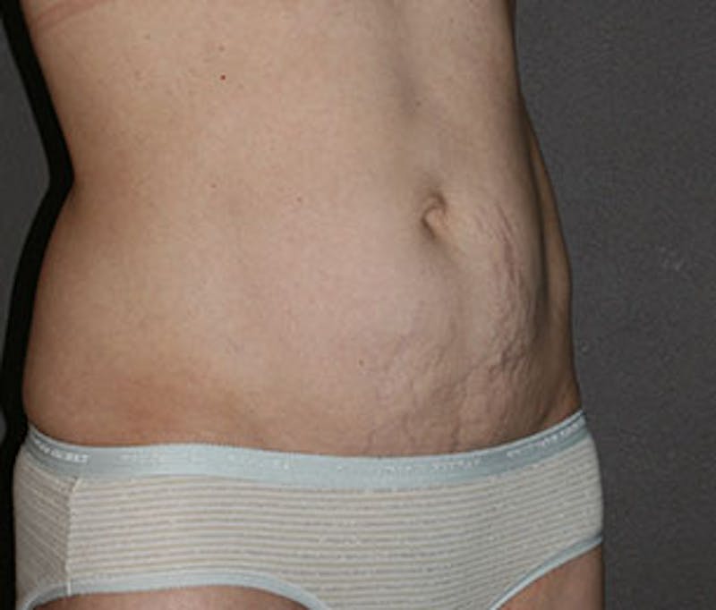 Mommy Makeover Before & After Gallery - Patient 3891472 - Image 7
