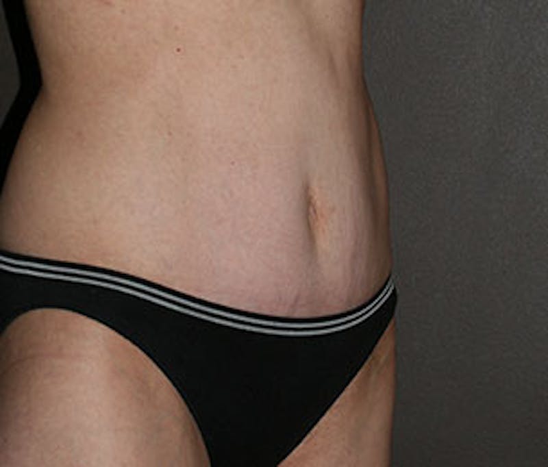 Mommy Makeover Before & After Gallery - Patient 3891472 - Image 8