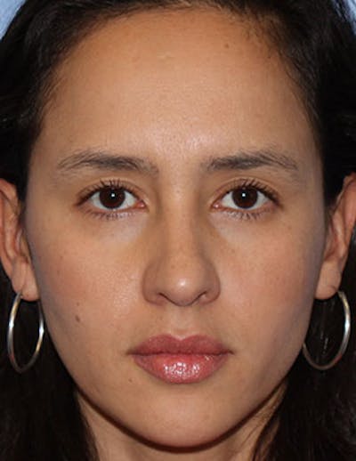 BOTOX Before & After Gallery - Patient 3891470 - Image 1