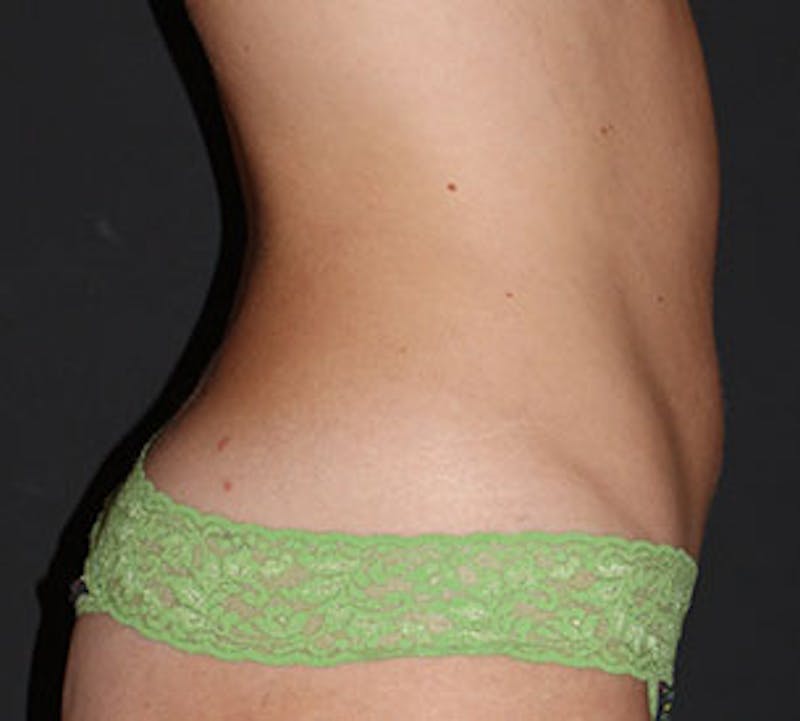 Liposuction Before & After Gallery - Patient 3891467 - Image 8