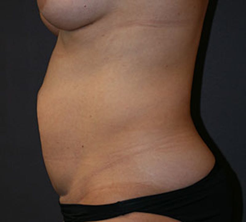 Abdominoplasty (Tummy Tuck) Before & After Gallery - Patient 3891466 - Image 9