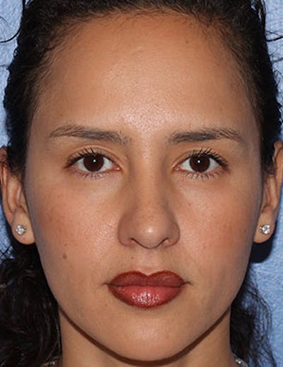 BOTOX Before & After Gallery - Patient 3891470 - Image 2