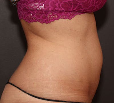 CoolSculpting® Gallery - Patient 3891468 - Image 2