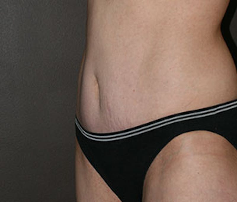 Mommy Makeover Before & After Gallery - Patient 3891472 - Image 12