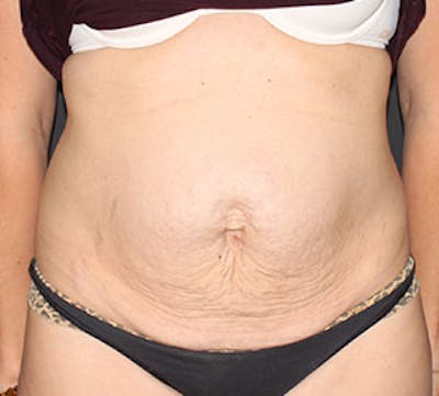 Abdominoplasty (Tummy Tuck) Before & After Gallery - Patient 3891473 - Image 1