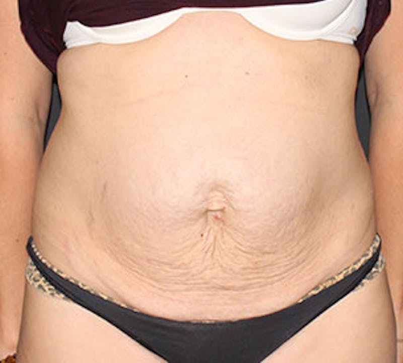 Abdominoplasty (Tummy Tuck) Before & After Gallery - Patient 3891473 - Image 1