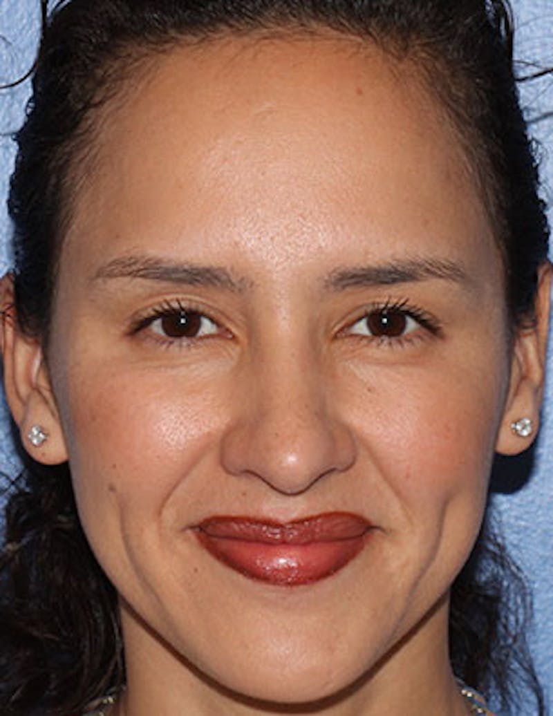 BOTOX Before & After Gallery - Patient 3891470 - Image 4