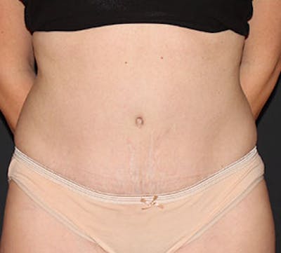 Abdominoplasty (Tummy Tuck) Before & After Gallery - Patient 3891473 - Image 2