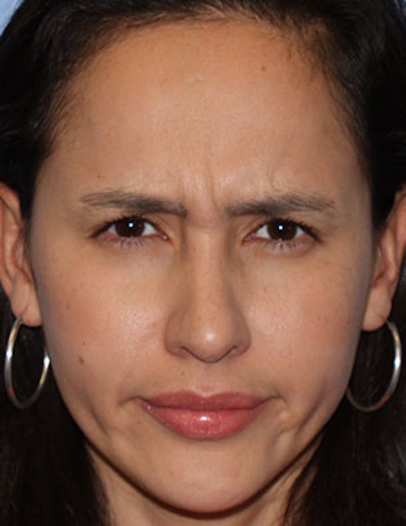 BOTOX Before & After Gallery - Patient 3891470 - Image 7