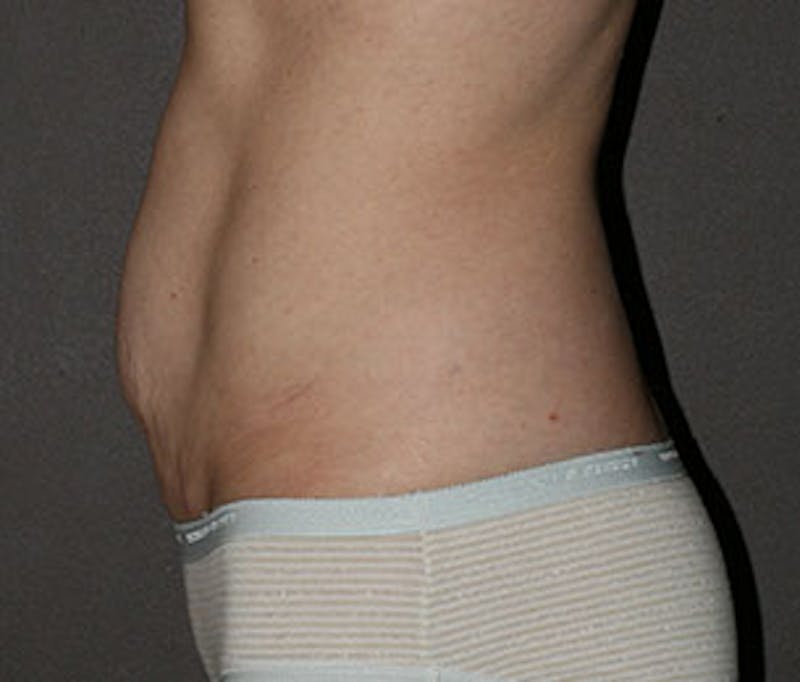 Mommy Makeover Before & After Gallery - Patient 3891472 - Image 19