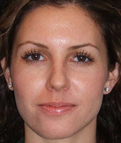 BOTOX Before & After Gallery - Patient 3891474 - Image 1