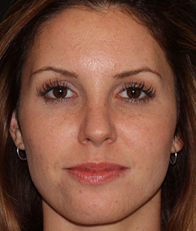 BOTOX Before & After Gallery - Patient 3891474 - Image 2