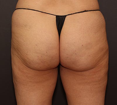 Cellfina Before & After Gallery - Patient 3891475 - Image 2