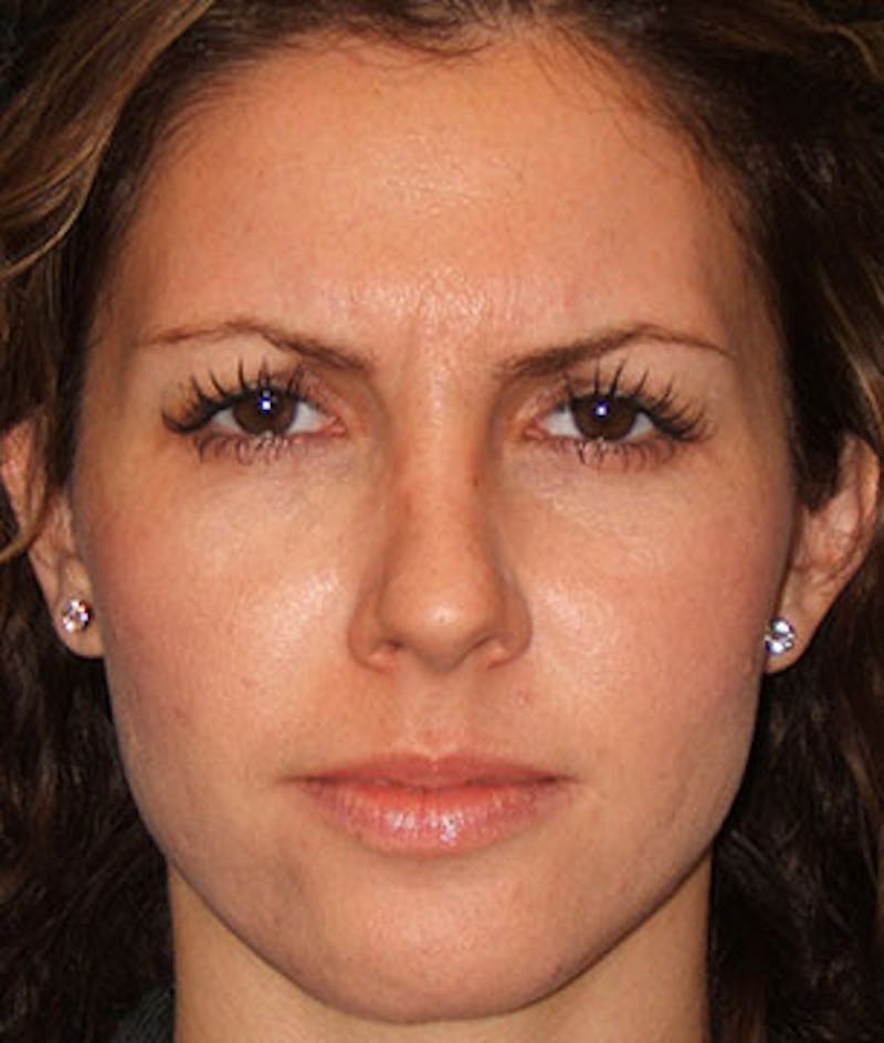 BOTOX Before & After Gallery - Patient 3891474 - Image 3