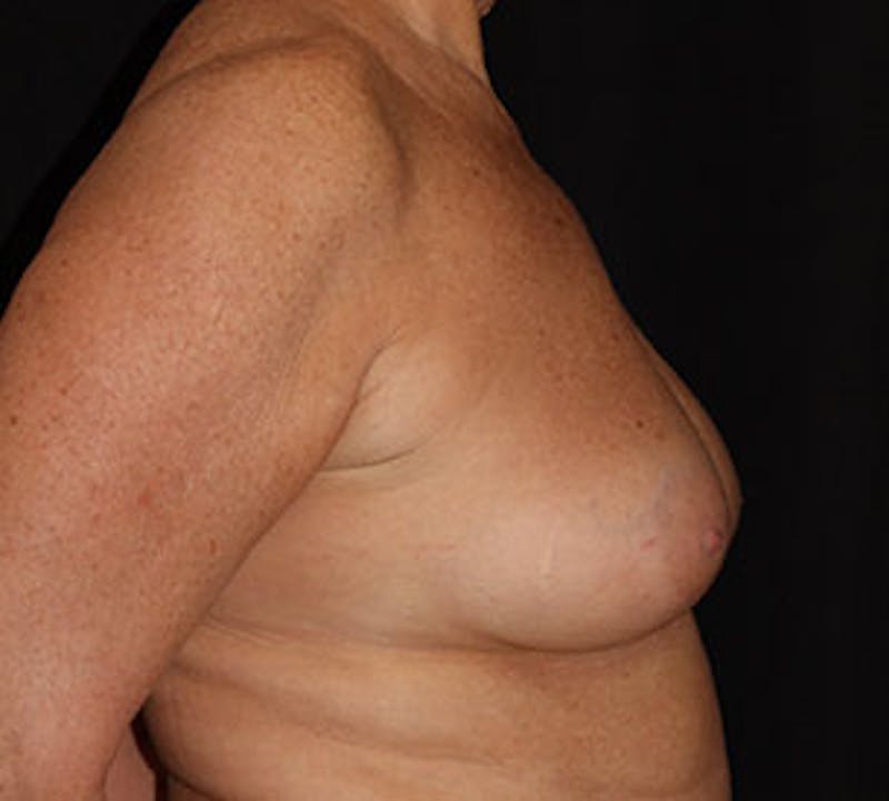 Breast Reconstruction Before & After Gallery - Patient 3891476 - Image 7