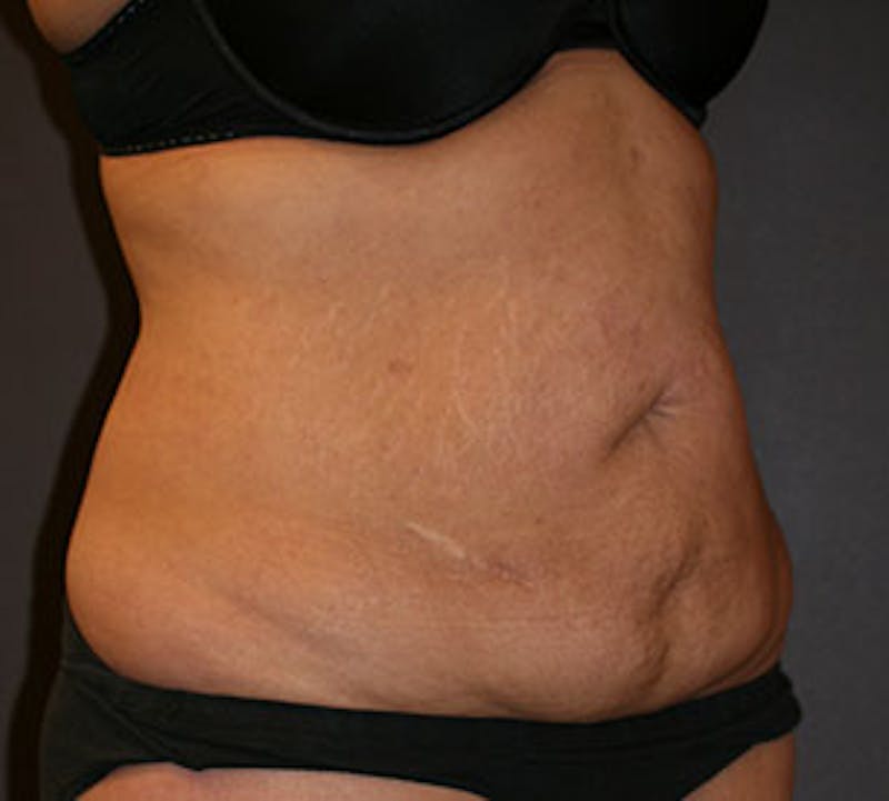 Abdominoplasty (Tummy Tuck) Before & After Gallery - Patient 3891479 - Image 3