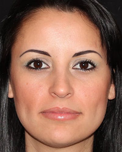 BOTOX Before & After Gallery - Patient 3891477 - Image 2