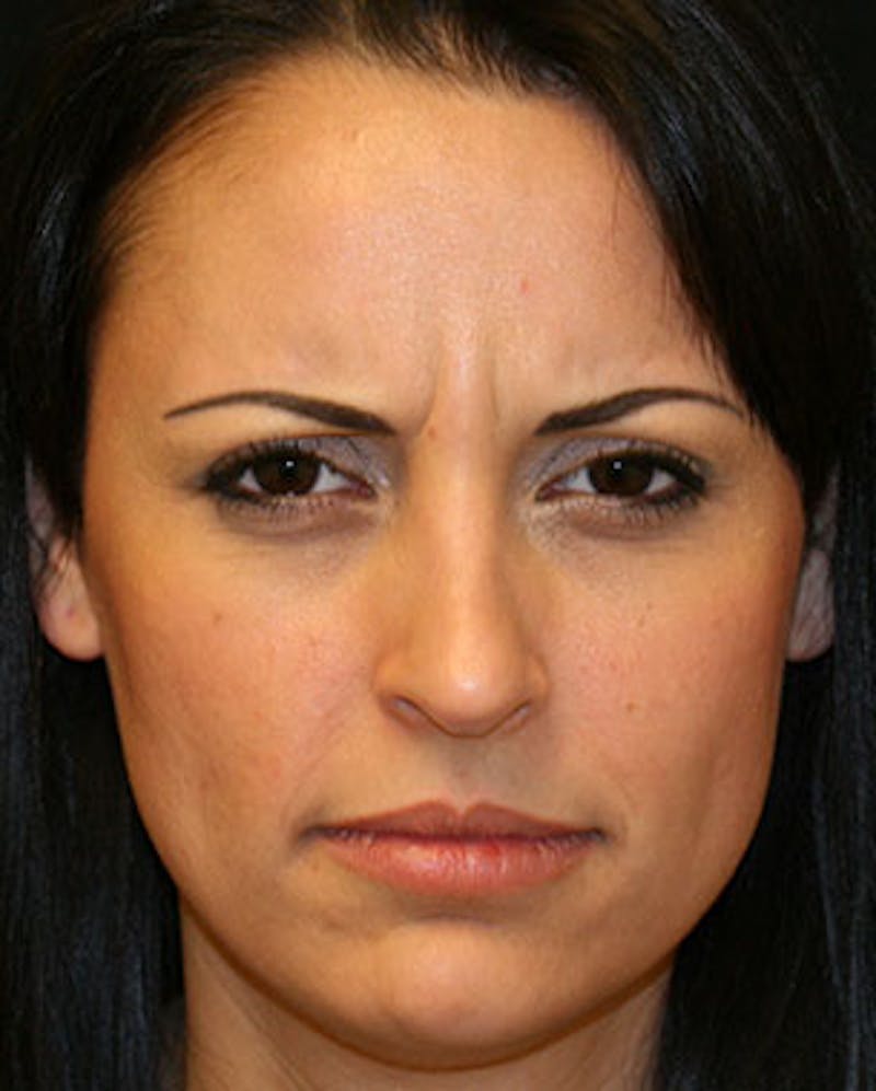 BOTOX Before & After Gallery - Patient 3891477 - Image 3