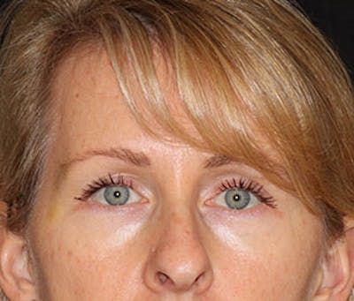 BOTOX Before & After Gallery - Patient 3891483 - Image 2