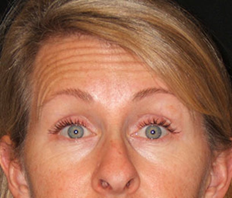 BOTOX Before & After Gallery - Patient 3891483 - Image 5