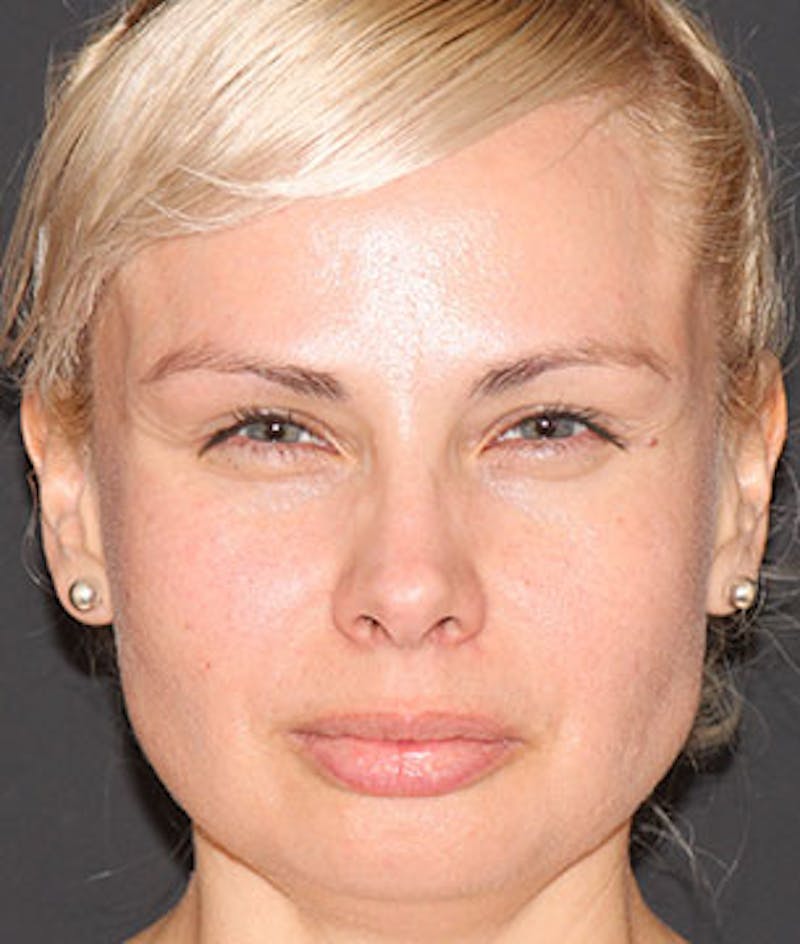 BOTOX Before & After Gallery - Patient 3891485 - Image 4