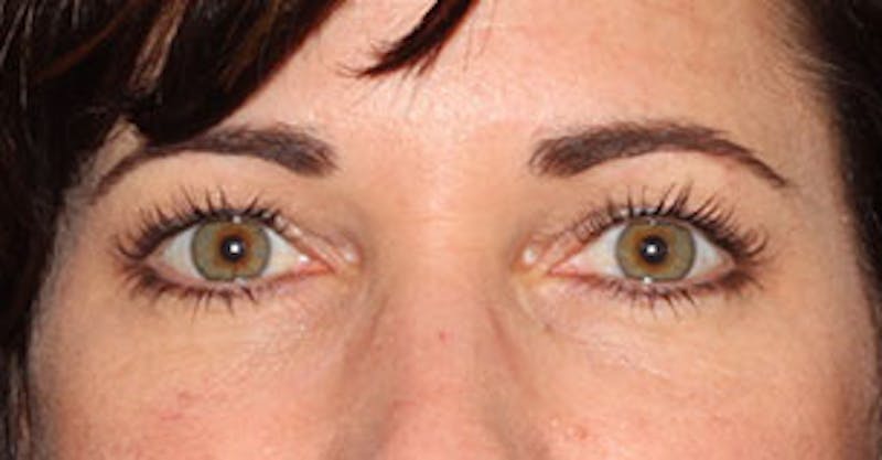 BOTOX Before & After Gallery - Patient 3891487 - Image 2